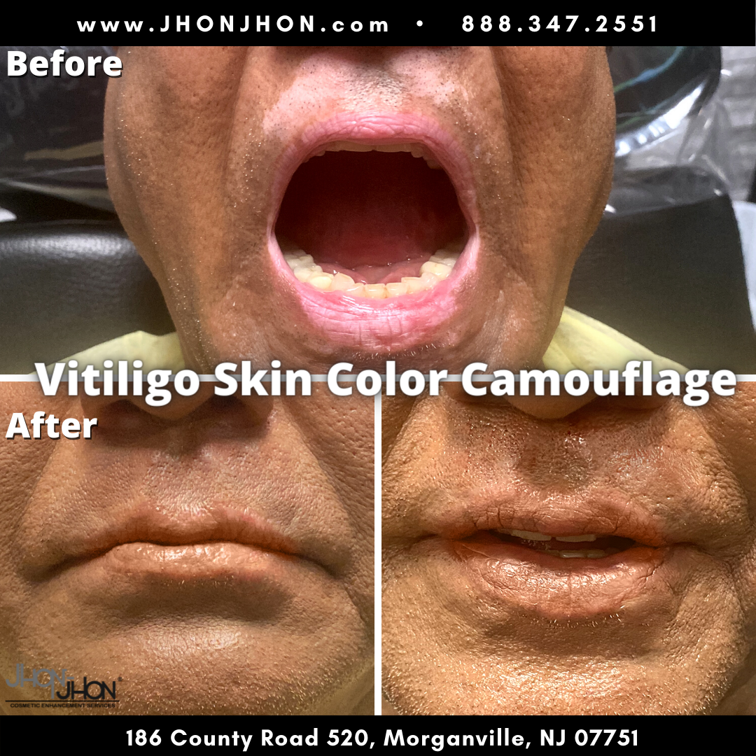 Skin color camouflage - THE JHON-JHON INSTITUTE