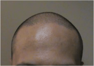 Hair Follicle Replication Scalp Micropigmentation Morganville NJ