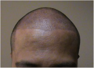 Scalp Micropigmentation Morganville NJ