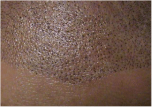 Hair Follicle Replication Morganville NJ