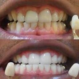 Before & After Teeth Whitening Morganville NJ