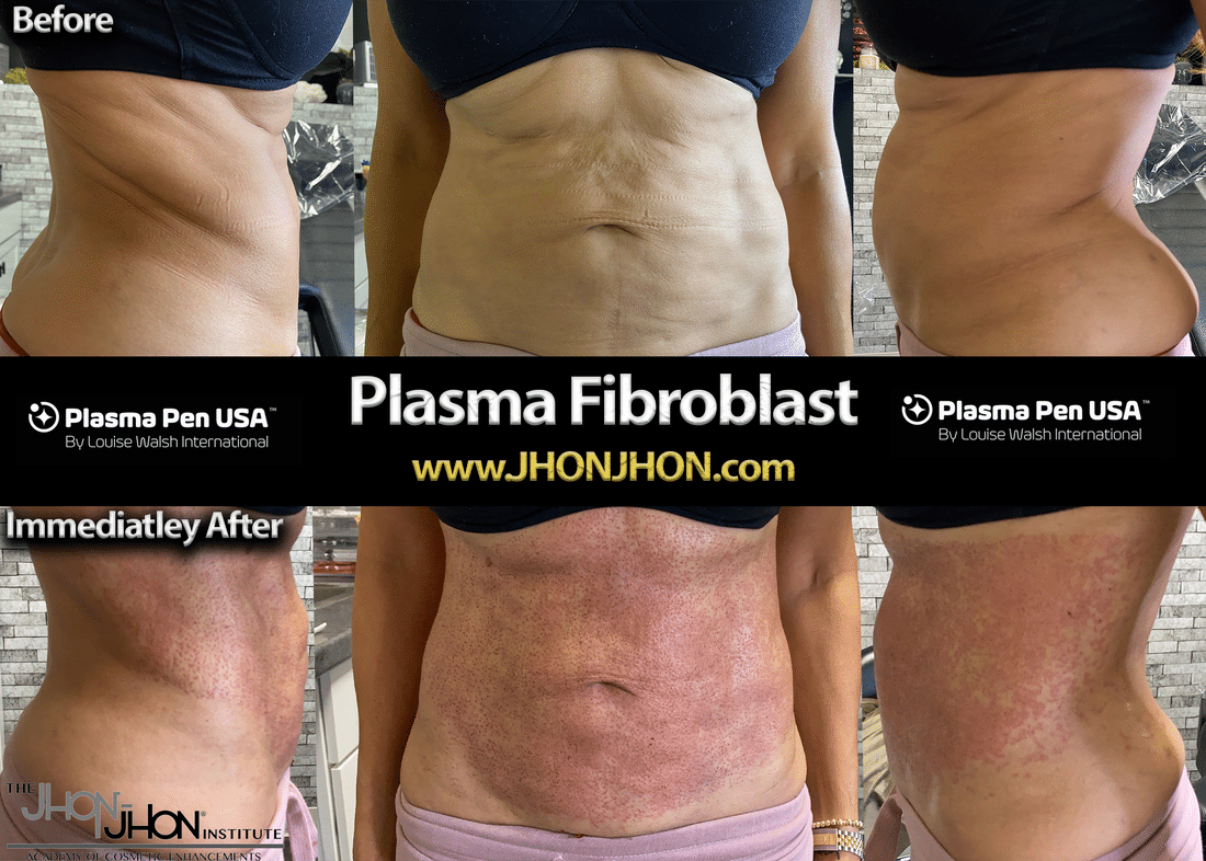 plasma stomach full before and after 1 2
