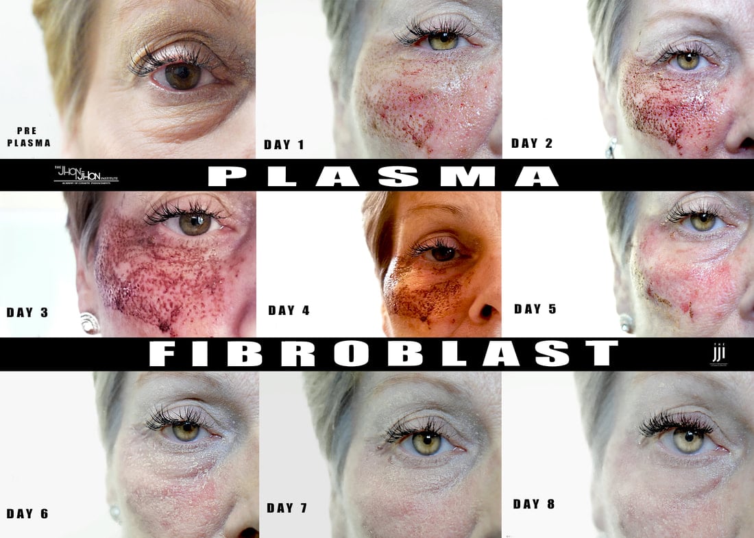 Before & After photos Plasma Morganville NJ