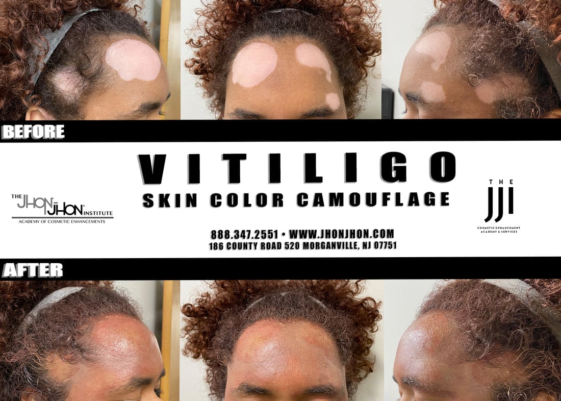 vitiligo skin color camouflage forehead 1