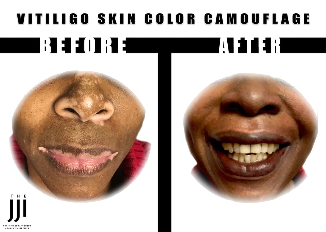 vitiligo face before and after orig