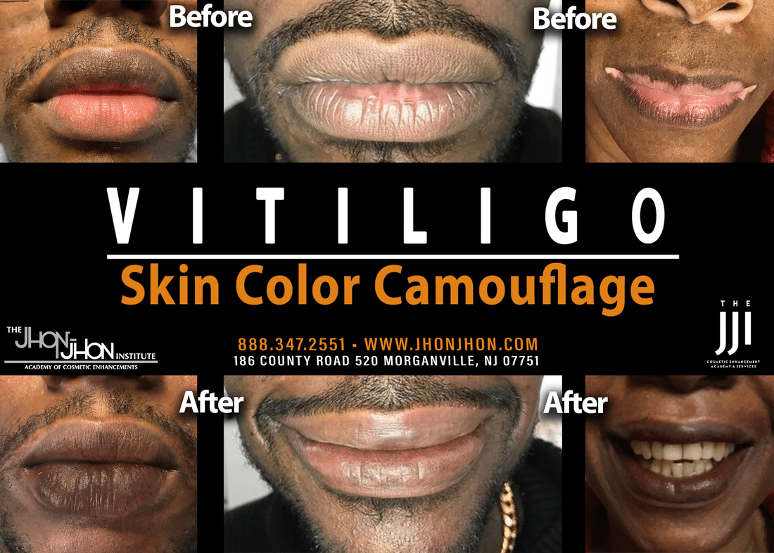 vitiligo skin color camouflage 2 orig