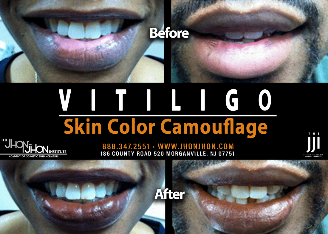 vitiligo skin color camouflage lip 1 orig