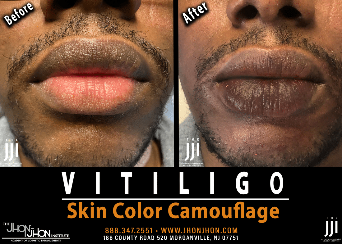 vitiligo skin color camouflage lips 2 orig