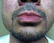 After Image: Scalp Micropigmentation - front