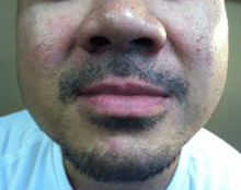 Before Image: Scalp Micropigmentation - front