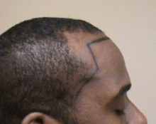 Before Image: Scalp Micropigmentation - right-side