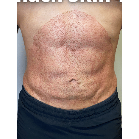 After Image: Stomach Skin Tightening - 