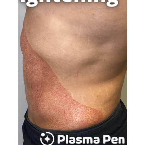 After Image: Stomach Skin Tightening - left-side