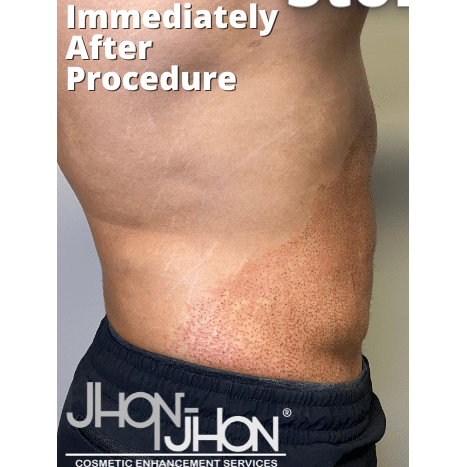 After Image: Stomach Skin Tightening - right-side
