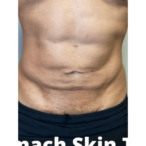 Before Image: Stomach Skin Tightening - 