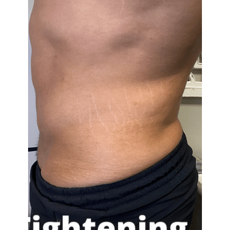 Before Image: Stomach Skin Tightening - left-side