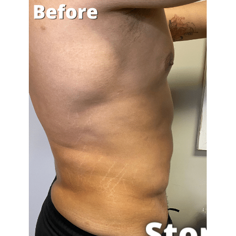 Before Image: Stomach Skin Tightening - right-side