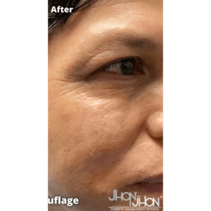 After Image: Vitiligo Skin Color Camouflage