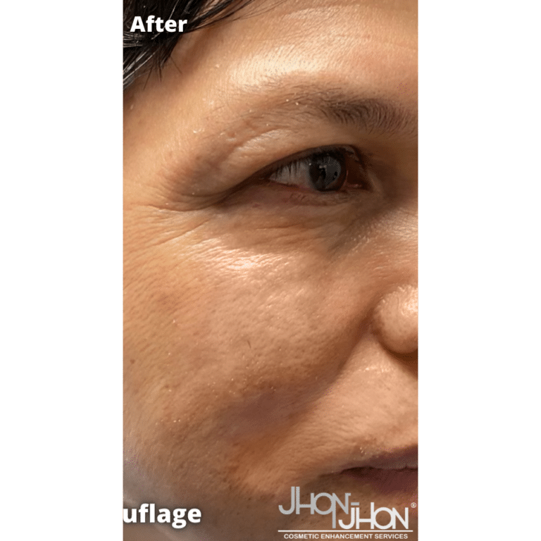 After Image: Vitiligo Skin Color Camouflage - right-front-oblique