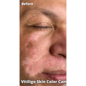 Before Image: Vitiligo Skin Color Camouflage