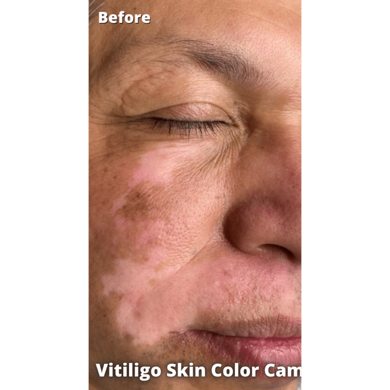 Before Image: Vitiligo Skin Color Camouflage - right-front-oblique