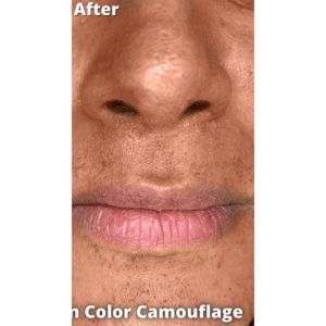 After Image: Vitiligo Skin Color Camouflage