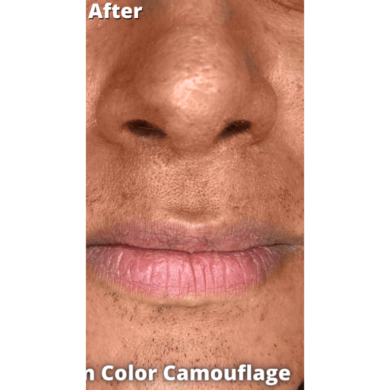 After Image: Vitiligo Skin Color Camouflage - front