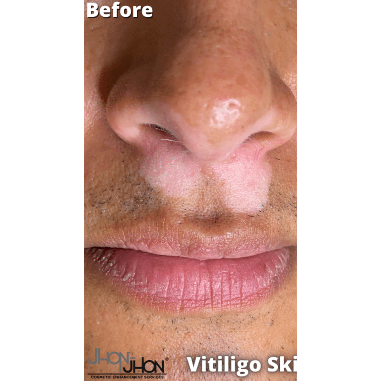 Before Image: Vitiligo Skin Color Camouflage - front